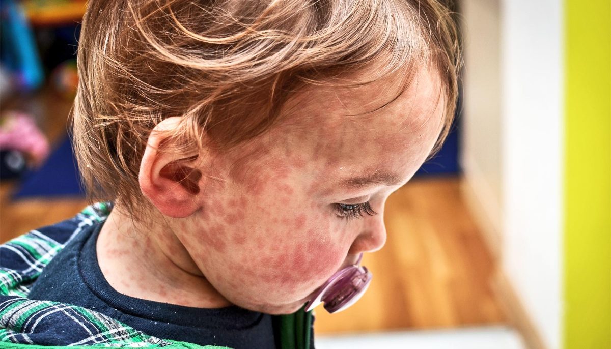 A little boy soothes himself with a pacifier while suffering a measles rash.  (2019 Courtesy of Getty Images)
